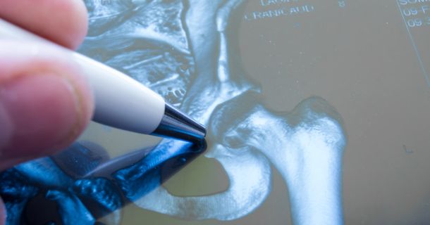 Arzt bewertet Hüftarthrose von Patienten und empfiehlt Operation